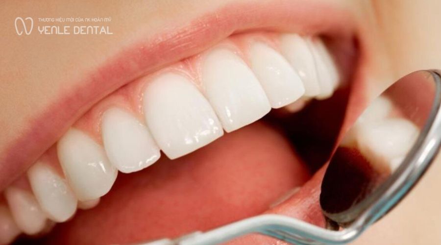 Khi nào nên niềng răng bọc sứ